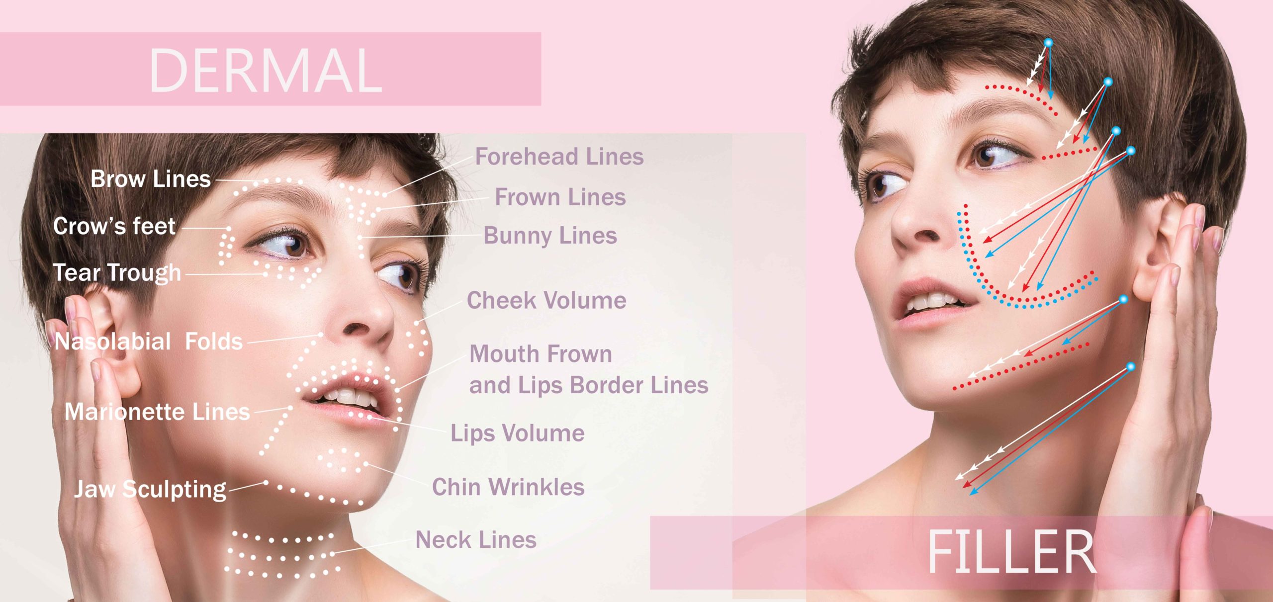Dermal-fillers-By-R-And-R-Aesthetic-Medicine-in-Kent-WA